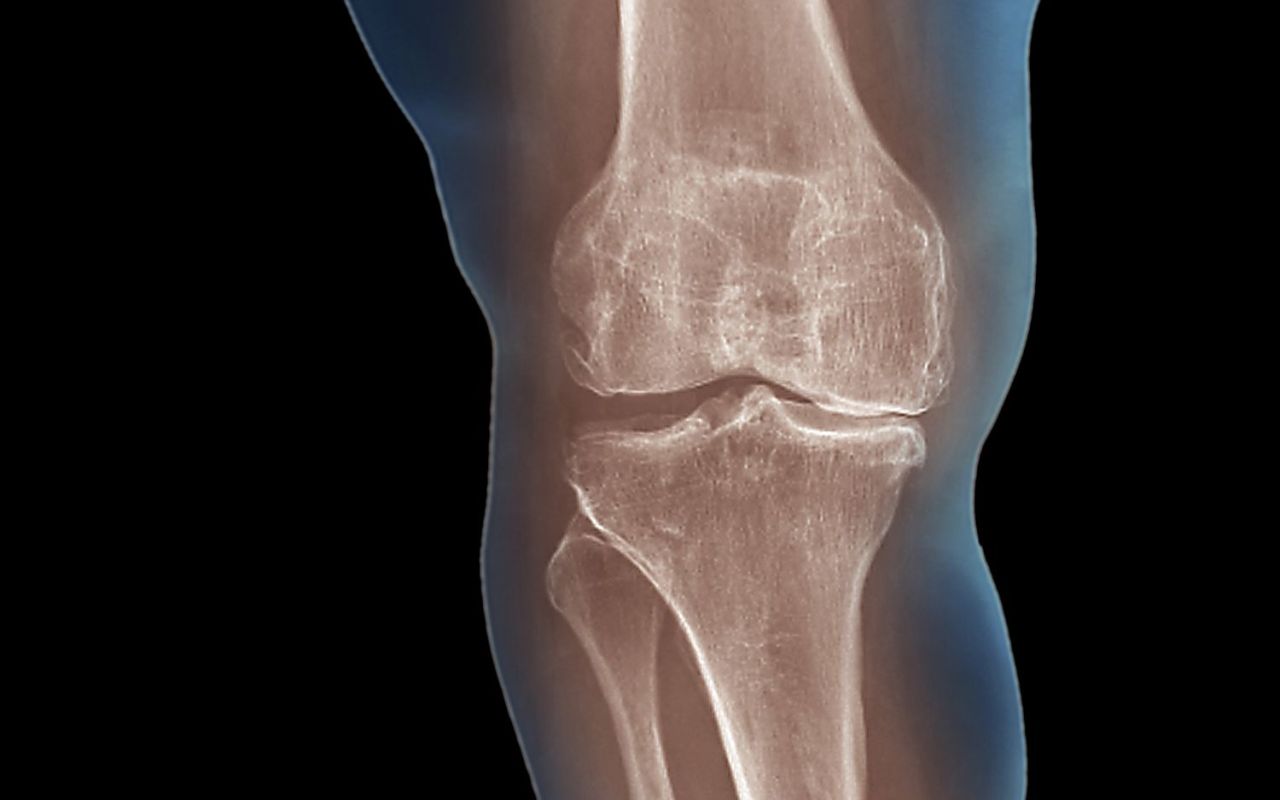 x-ray of a knee joint