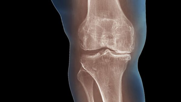 x-ray of a knee joint